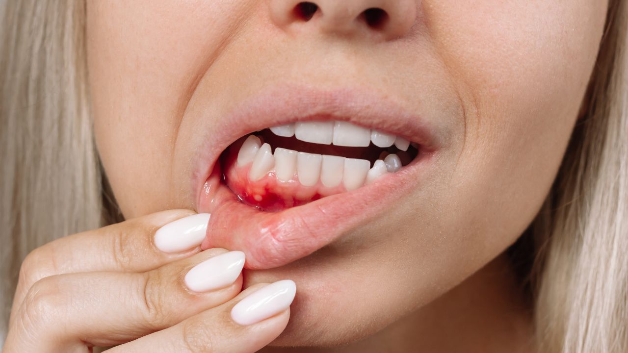Pyorrhea / Bleeding Gums